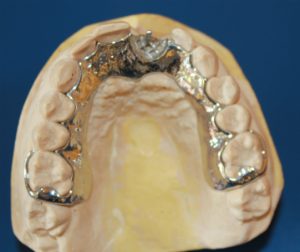 Partial Denture